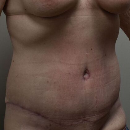 Tummy Tuck (Abdominoplasty): Case 516 - After