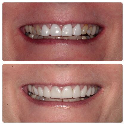 Advanced Cosmetic and Implant Cases Case 1