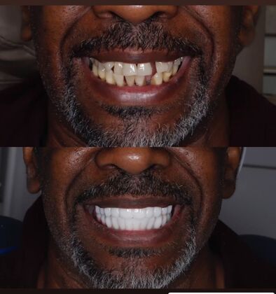 Advanced Cosmetic and Implant Cases Case 2