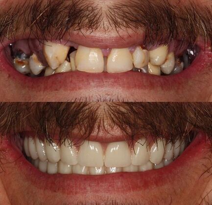 Advanced Cosmetic and Implant Cases Case 3