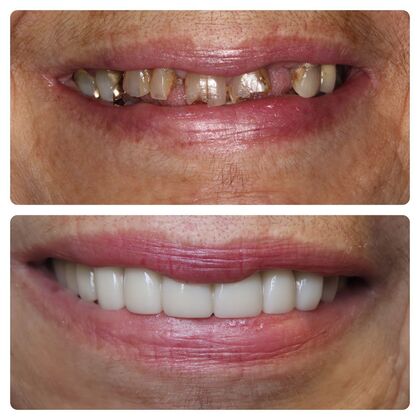 Advanced Cosmetic and Implant Cases Case 4