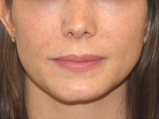 Injectables Case 78 - Before