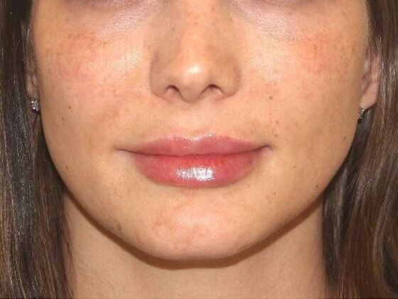 Injectables Case 78 - After