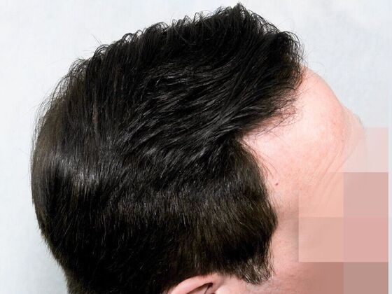 Hair Transplant Results: Case 3 - After