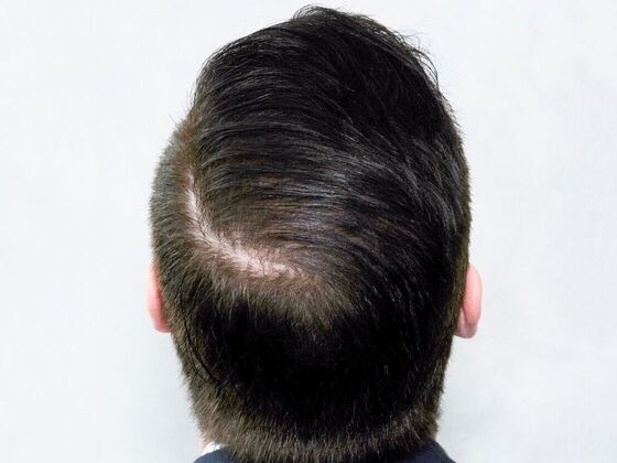 Hair Transplant Results: Case 3 - After