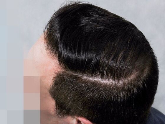 Hair Transplant Results: Case 3 - After