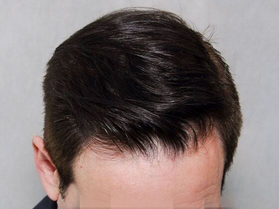 Hair Transplant Results Case 3 - After