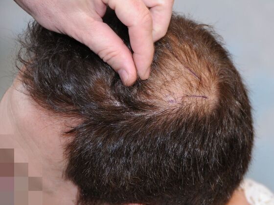 Hair Transplant Results: Case 3 - Before