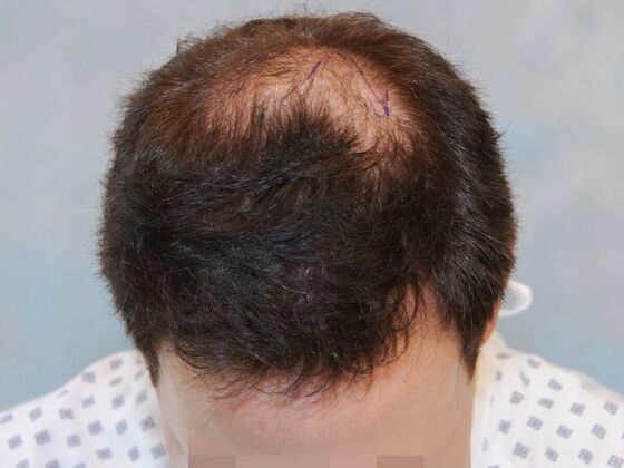 Hair Transplant Results Case 3 - Before
