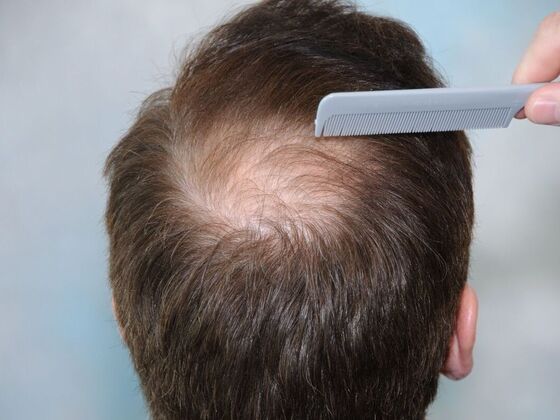 Hair Transplant Results: Case 3 - Before