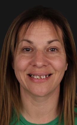 Dental Implants: Hanna Groat- Dental implants - Before