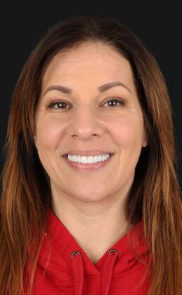 Dental Implants: Hanna Groat- Dental implants - After