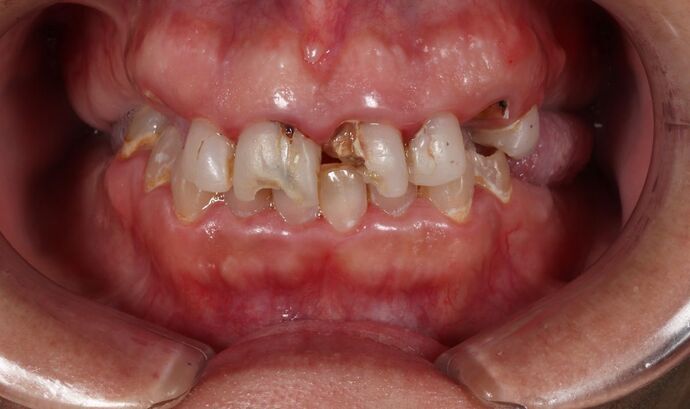 Dental Implants: Hanna Groat- Dental implants - Before