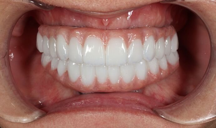 Dental Implants: Hanna Groat- Dental implants - After