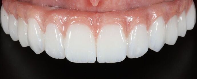 Dental Implants: Hanna Groat- Dental implants - After
