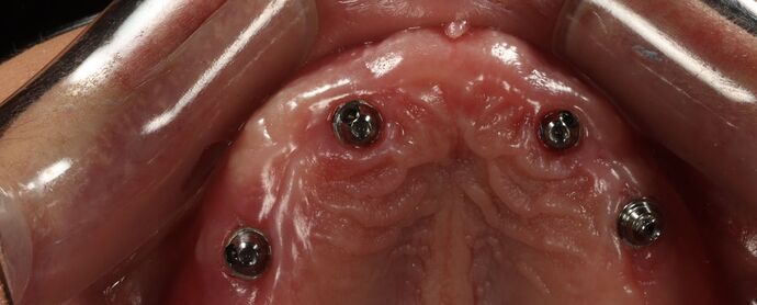 Dental Implants: Hanna Groat- Dental implants - Before