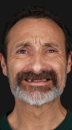 Dental Implants: Mathew - full set of implants - Before