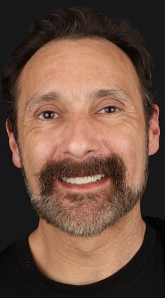 Dental Implants: Mathew - full set of implants - After