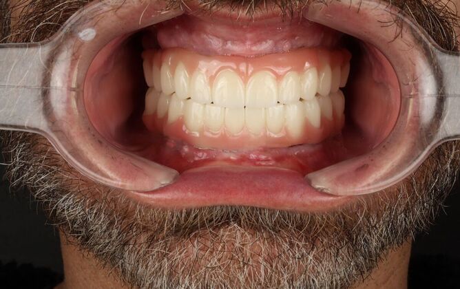 Dental Implants: Mathew - full set of implants - After