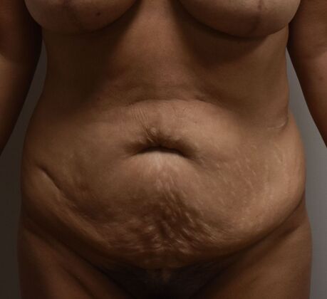 Tummy Tuck (Abdominoplasty): Case 517 - Before