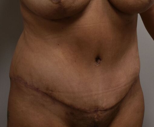 Tummy Tuck (Abdominoplasty): Case 517 - After