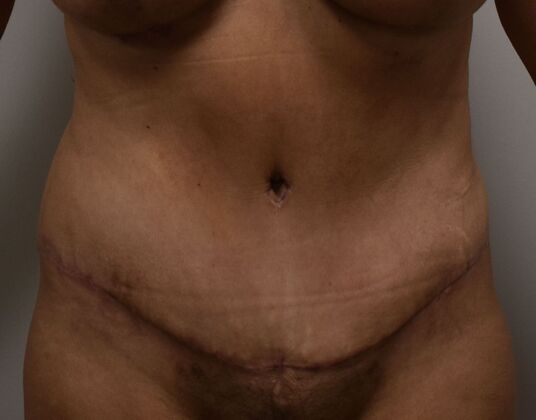 Tummy Tuck (Abdominoplasty): Case 517 - After