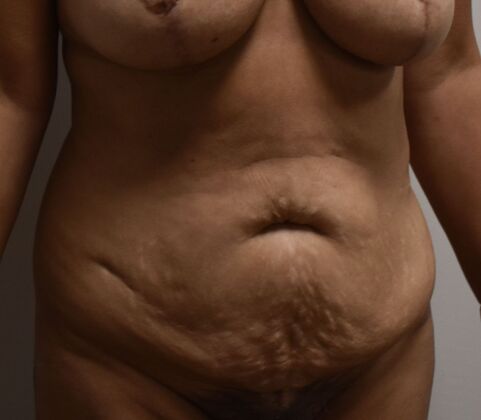 Tummy Tuck (Abdominoplasty): Case 517 - Before