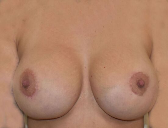 Breast Revision: Case 269 - After