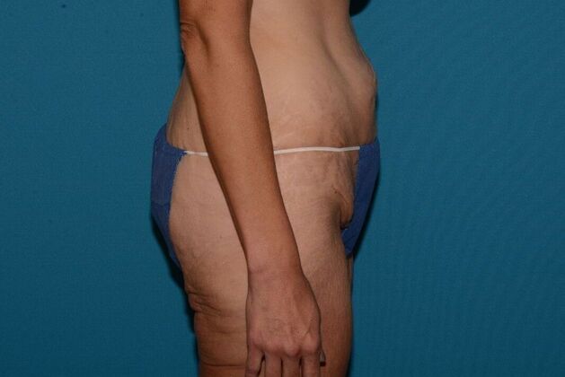 Torsoplasty: Case 3 - Zionsville - Before