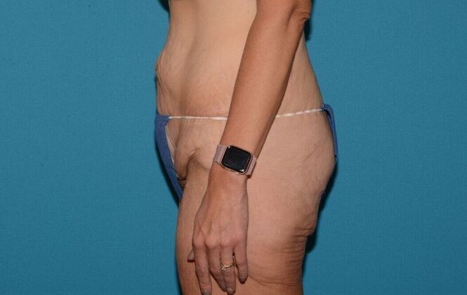 Torsoplasty: Case 3 - Zionsville - Before