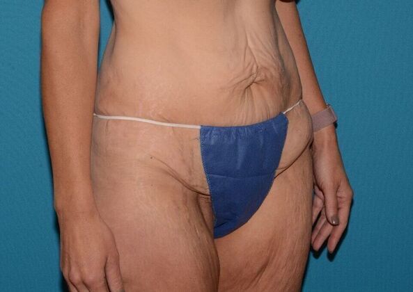 Torsoplasty: Case 3 - Zionsville - Before