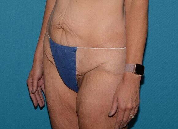 Torsoplasty: Case 3 - Zionsville - Before