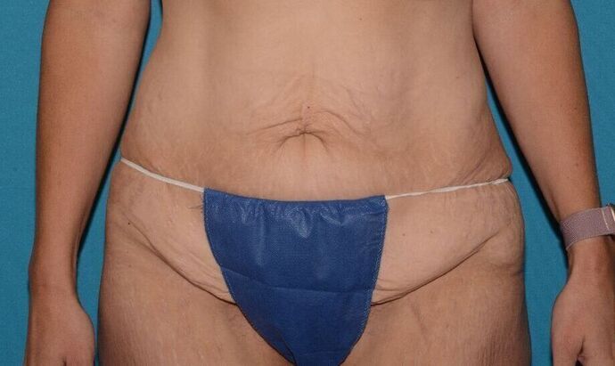 Torsoplasty Case 3 - Zionsville - Before