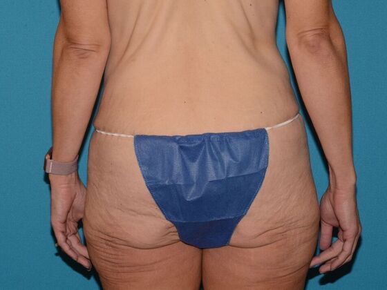 Torsoplasty: Case 3 - Zionsville - Before