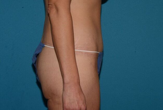 Torsoplasty: Case 3 - Zionsville - After