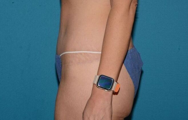 Torsoplasty: Case 3 - Zionsville - After