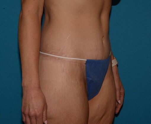 Torsoplasty: Case 3 - Zionsville - After