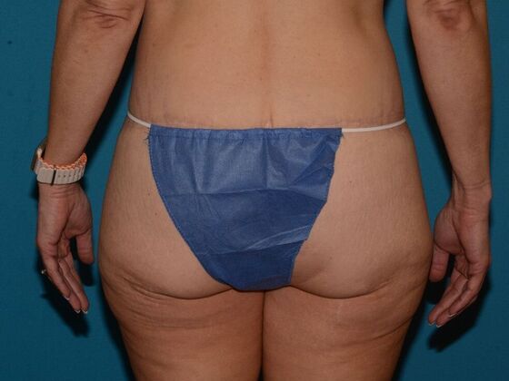 Torsoplasty: Case 3 - Zionsville - After