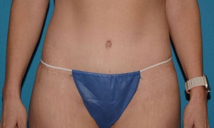 Torsoplasty Case 3 - Zionsville - After