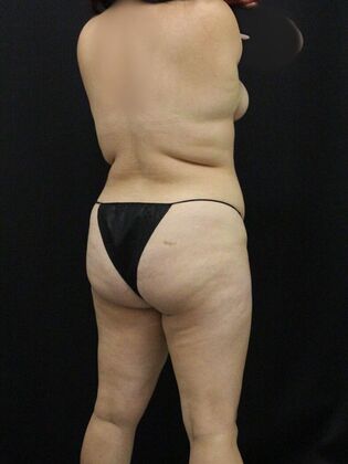 Liposuction: Case 52 - Before