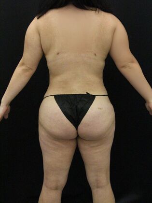 Liposuction Case 52 - After