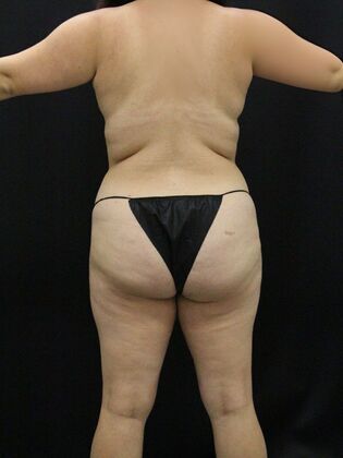 Liposuction Case 52 - Before
