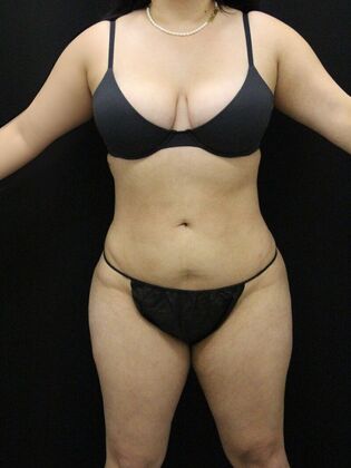 Liposuction: Case 52 - After