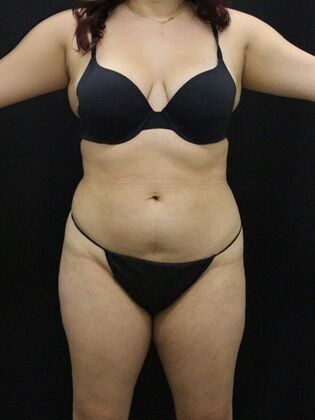 Liposuction: Case 52 - Before