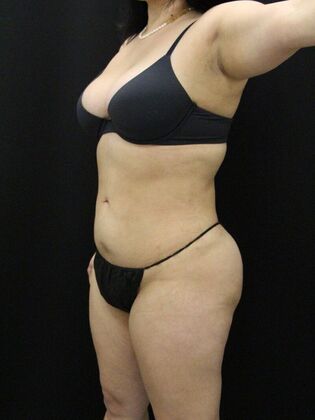 Liposuction: Case 52 - After