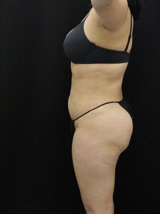 Liposuction: Case 52 - After