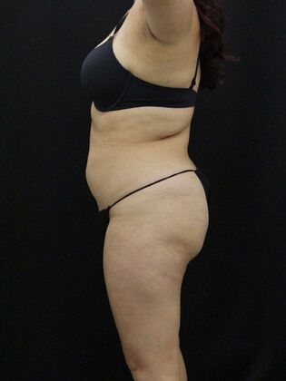 Liposuction: Case 52 - Before