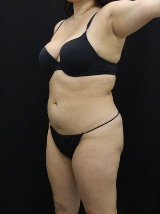 Liposuction: Case 52 - Before