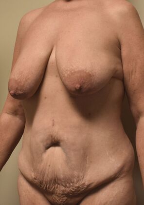 Massive Weight Loss : Case 165 - Before