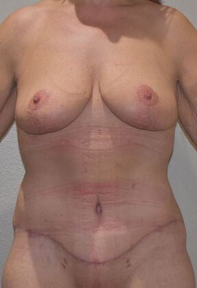 Massive Weight Loss : Case 165 - After